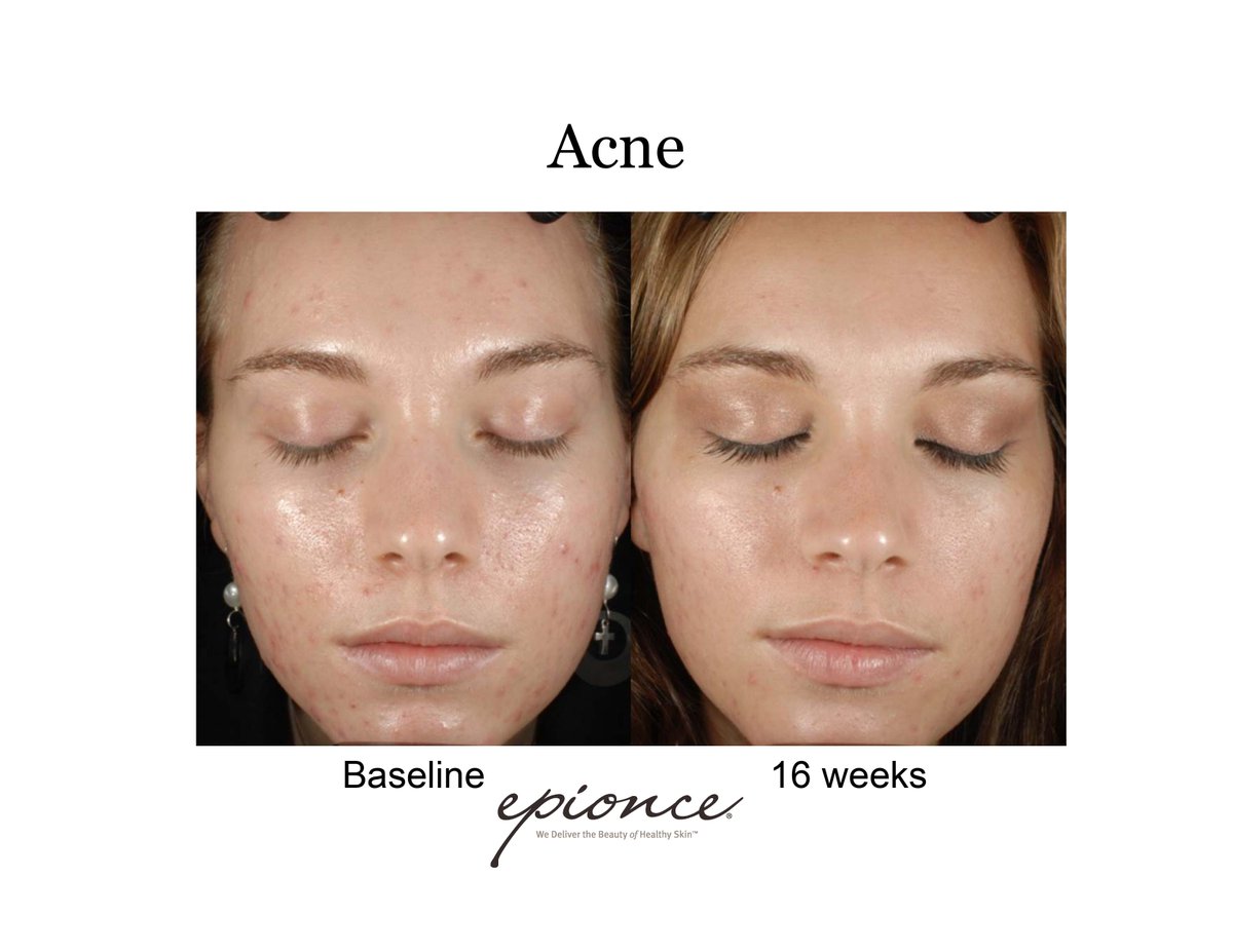 Call or text 208-425-2478 to pick your Epionce.  Buy get second product 50% off!!!
#acne #skincare #beauty #skin #skincareroutine #antiaging #acnetreatment #facial #glowingskin #healthyskin #skincaretips #skincareproducts #selfcare #pimples #acnescars #makeup #pullmanwa #moscowid