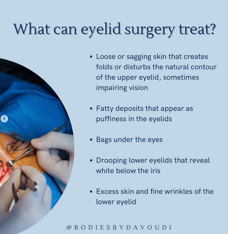 Eyelid Surgery (Blepharoplasty) myatlantaplasticsurgeon.com/html/eyelidsur… #eyelidsurgery #blepharoplasty