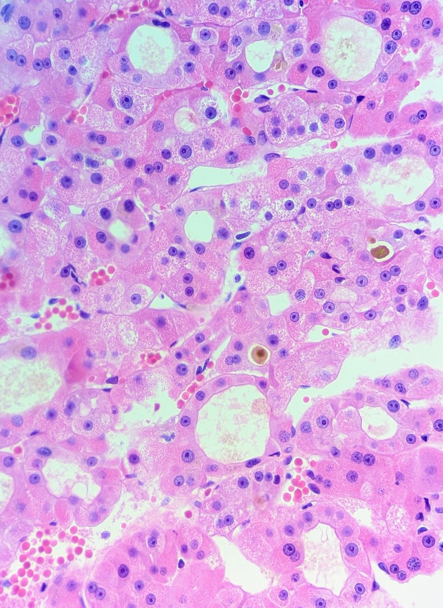 Dr_Brian_Cox's tweet image. Bile: my favorite "special stain" if HCC is in the differential. 

Bonus points if you can tell me the predominant growth pattern here.

#pathresidents