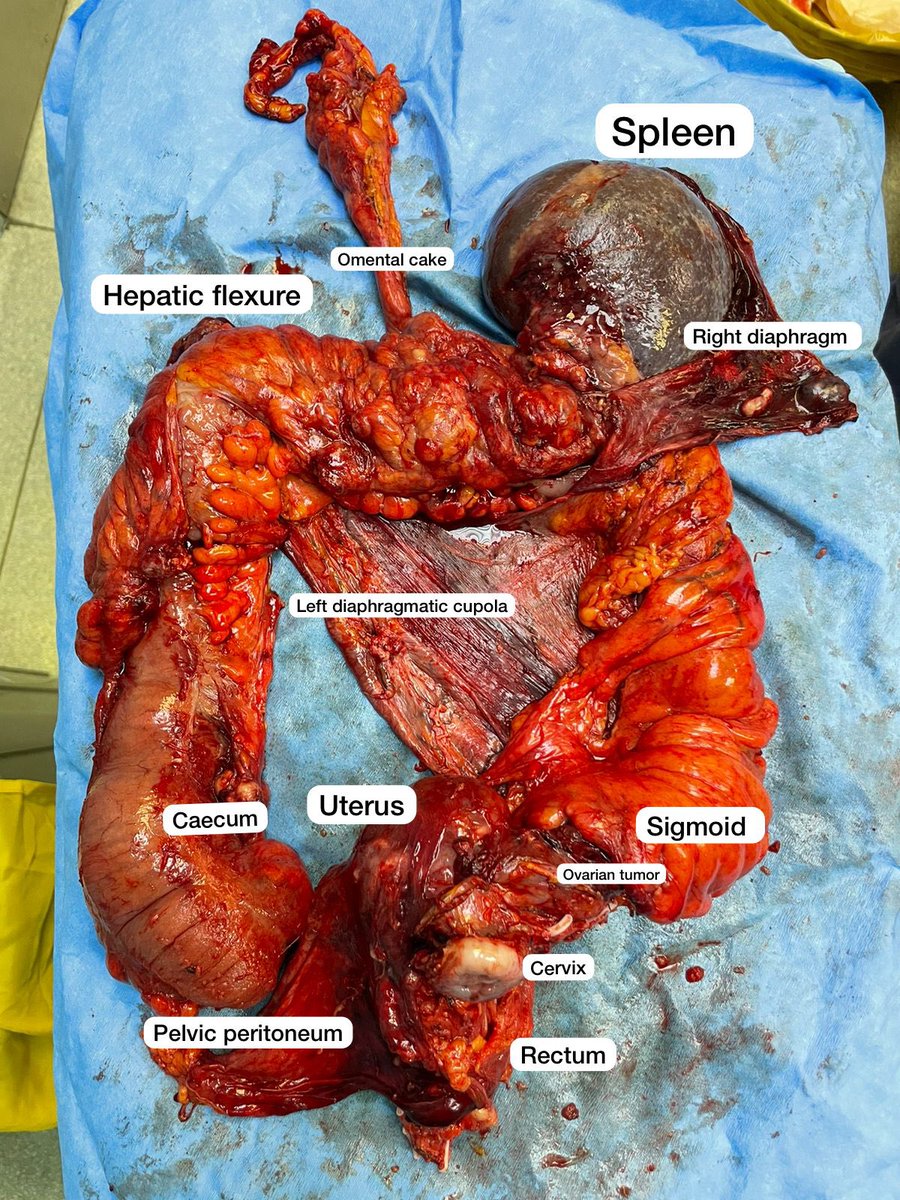 When it’s resectable, never hesitate to do it. 
A Primary debulking surgery is always the best decision for the PFS and OS.
This a complete resection of peritoneal carcinomatosis en bloc with the uterus, the colon, spleen and omentum . 
Done by Pr <a href="/DavidAtallah/">david atallah</a> <a href="/hdf_lb/">Hôtel-Dieu de France</a>