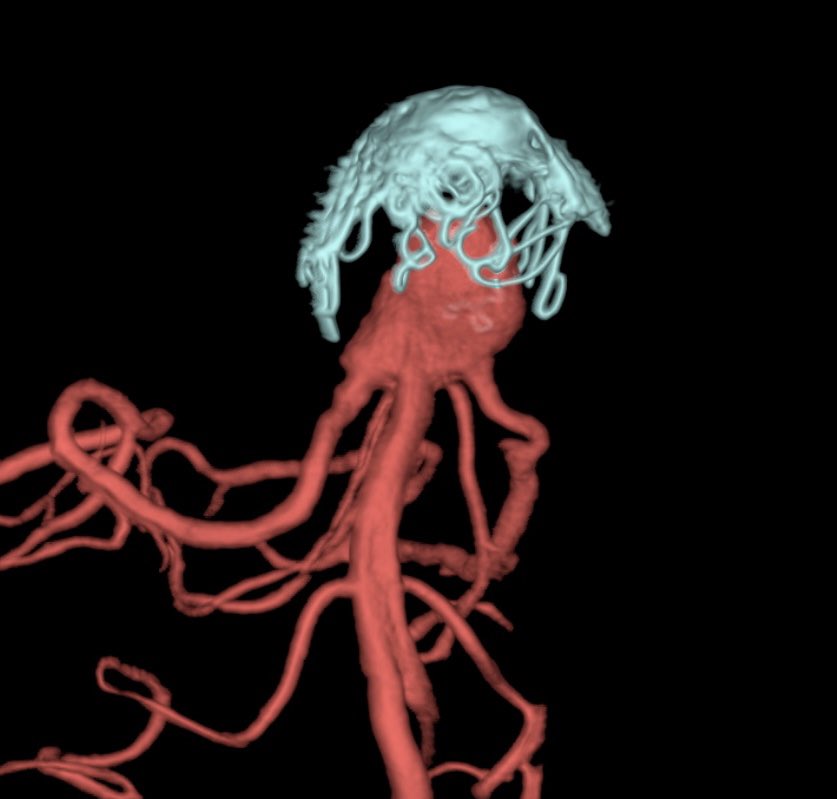 ikeafonso1's tweet photo. A basilar tip aneurysm previously coiled that grew up fast (during one year of FU). What to do now? https://t.co/NtMQhTDVcr