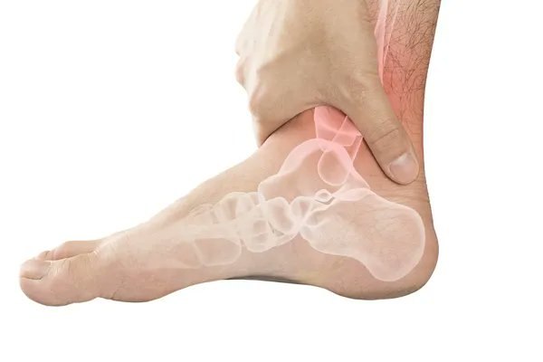 Uncover some of the telltale signs of arthritis in your foot! #BryantHoMD #footandanklespecialist #footandanklesurgeon #arthritis #footarthritis #foot bryanthomd.com/blog/signs-tha…