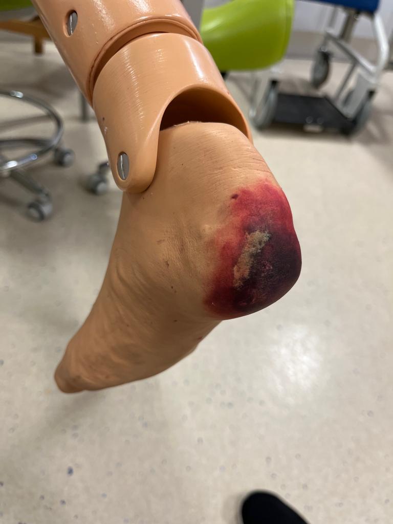 NGHSim&Resus (@nghsim_resus) on Twitter photo Our #simgranny manikin has developed some nasty pressure damage <a href="/NGHPPD/">NGH P&P Development</a> this is your fault! 😆 #notarealbottom #pressureareacare #simulation Our #simgranny manikin has developed some nasty pressure damage <a href="/NGHPPD/">NGH P&P Development</a> this is your fault! 😆 #notarealbottom #pressureareacare #simulation