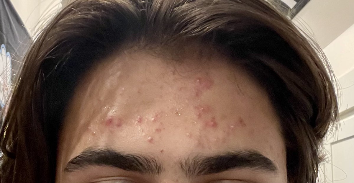 MaryBowdenMD's tweet photo. My son is struggling with acne. We noticed it was significantly better at the beach, so last night, I had him sleep with saline+betadine soaked gauze on his forehead.  Big difference after just one night…. https://t.co/MUC1iQajcG