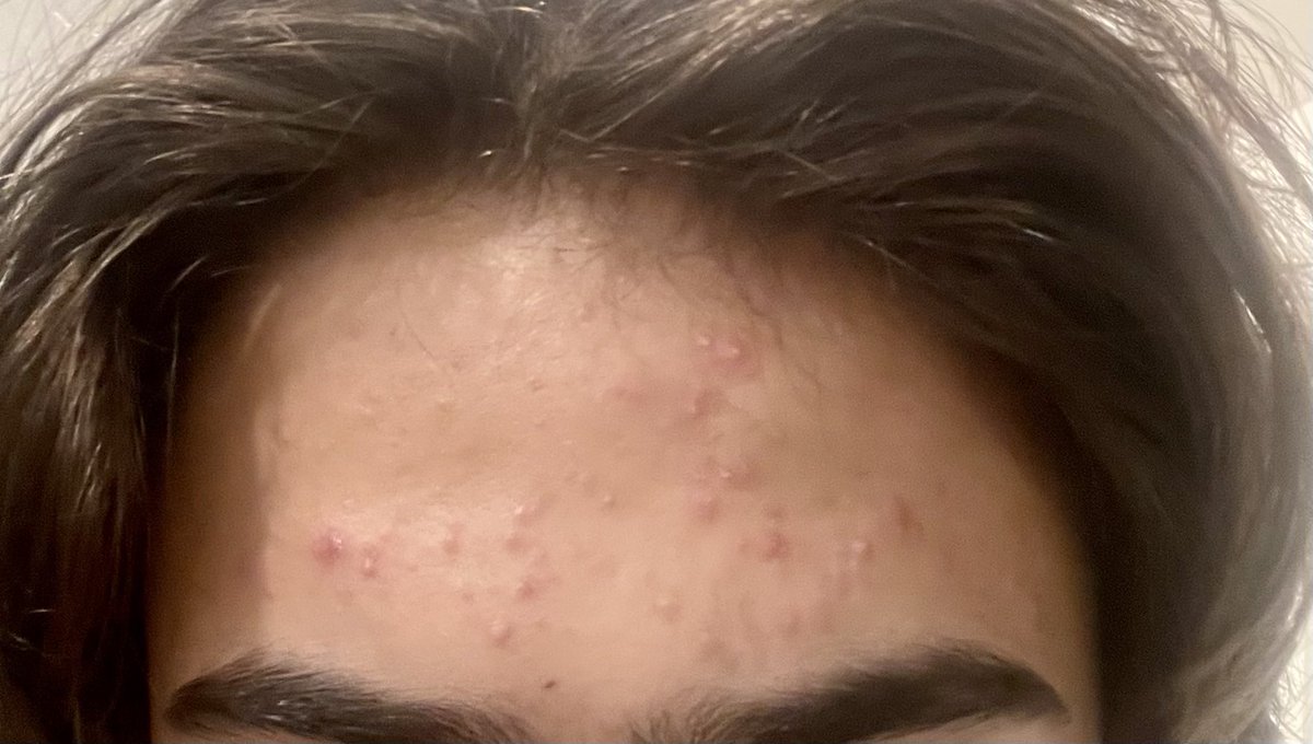 MaryBowdenMD's tweet photo. My son is struggling with acne. We noticed it was significantly better at the beach, so last night, I had him sleep with saline+betadine soaked gauze on his forehead.  Big difference after just one night…. https://t.co/MUC1iQajcG