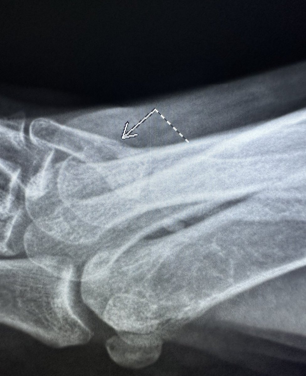 Finding subtle fractures can be very satisfying