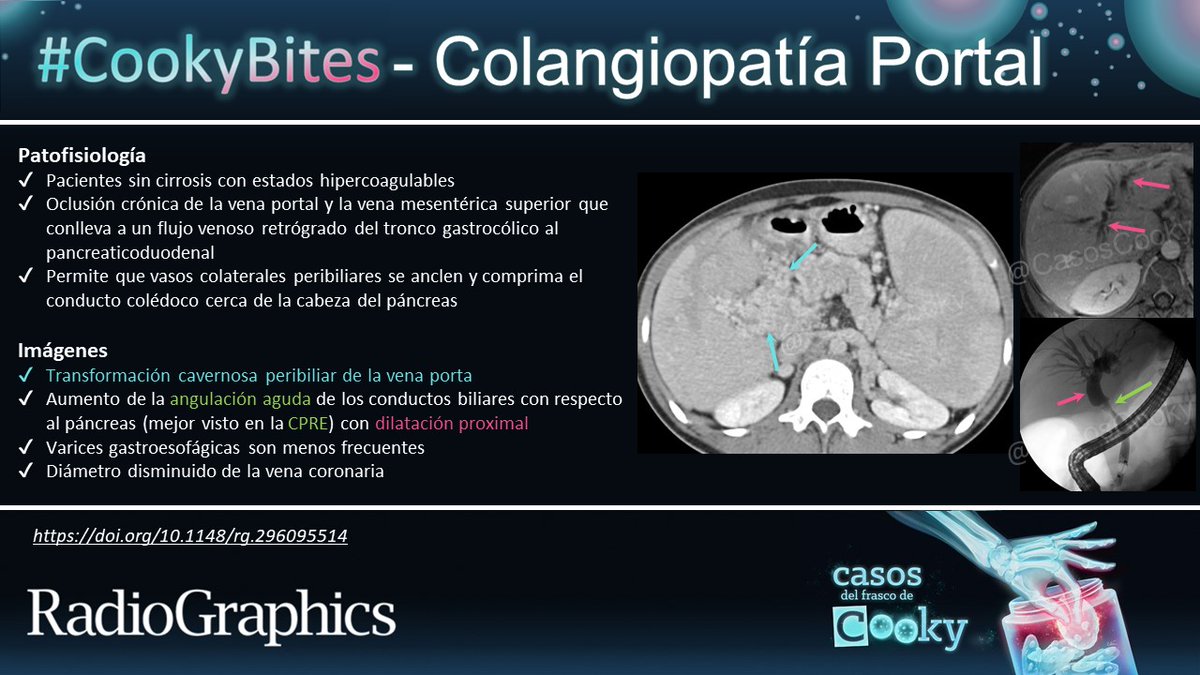 Casos de Cooky (@casoscooky) on Twitter photo Respuesta: Colangiopatía portal
Aprende más:
doi.org/10.1148/rg.296…
Traducido por: <a href="/CBarreraMD/">Christian Barrera, MD</a>
#CasosCooky #74 #CookyBites #RGphx <a href="/cookyscan1/">Cooky Menias</a> <a href="/RadioGraphics/">RadioGraphics</a> Respuesta: Colangiopatía portal
Aprende más:
doi.org/10.1148/rg.296…
Traducido por: <a href="/CBarreraMD/">Christian Barrera, MD</a>
#CasosCooky #74 #CookyBites #RGphx <a href="/cookyscan1/">Cooky Menias</a> <a href="/RadioGraphics/">RadioGraphics</a>