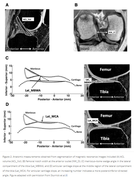 OJSM_SportsMed's tweet photo. Lateral meniscus–bone wedge angle in female patients and AP laxity in male patients exhibited thresholds where a pronounced increase or decrease in risk of first-time, noncontact #ACL injury occurred. #OrthoTwitter

Discover the details #OpenAccess here! https://t.co/kkvkmioAhr https://t.co/P5btgLpuBi