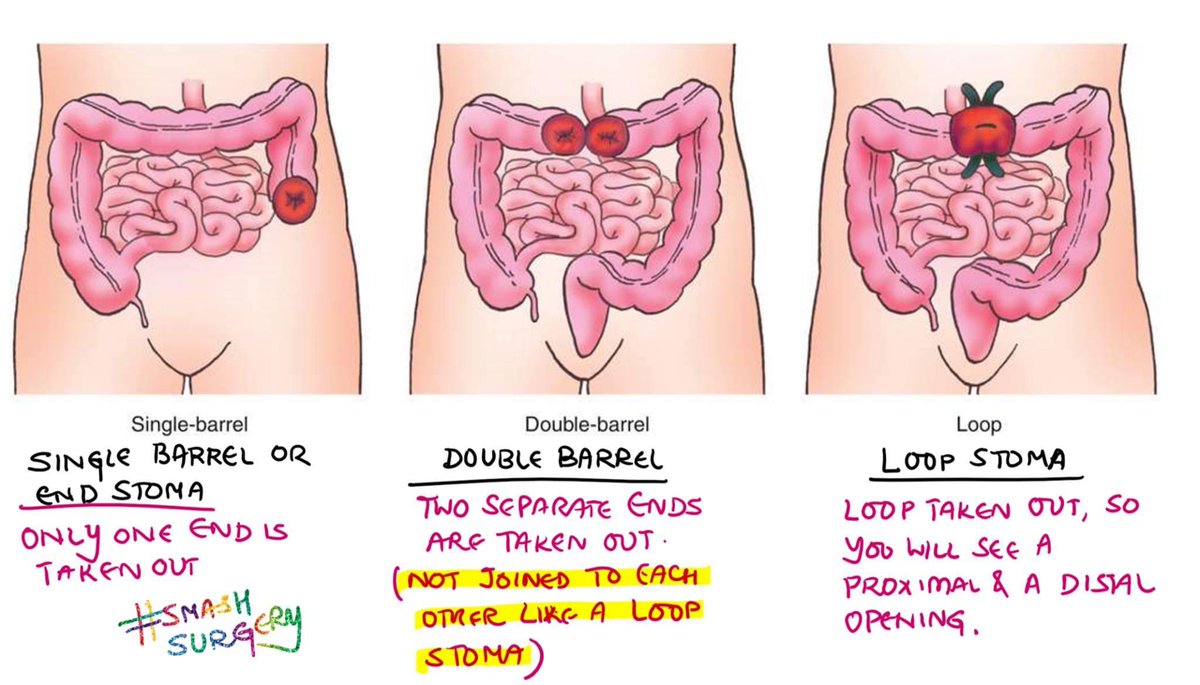 drkeithsiau's tweet photo. Types of stomas #GITwitter https://t.co/TNNrNYSOnx