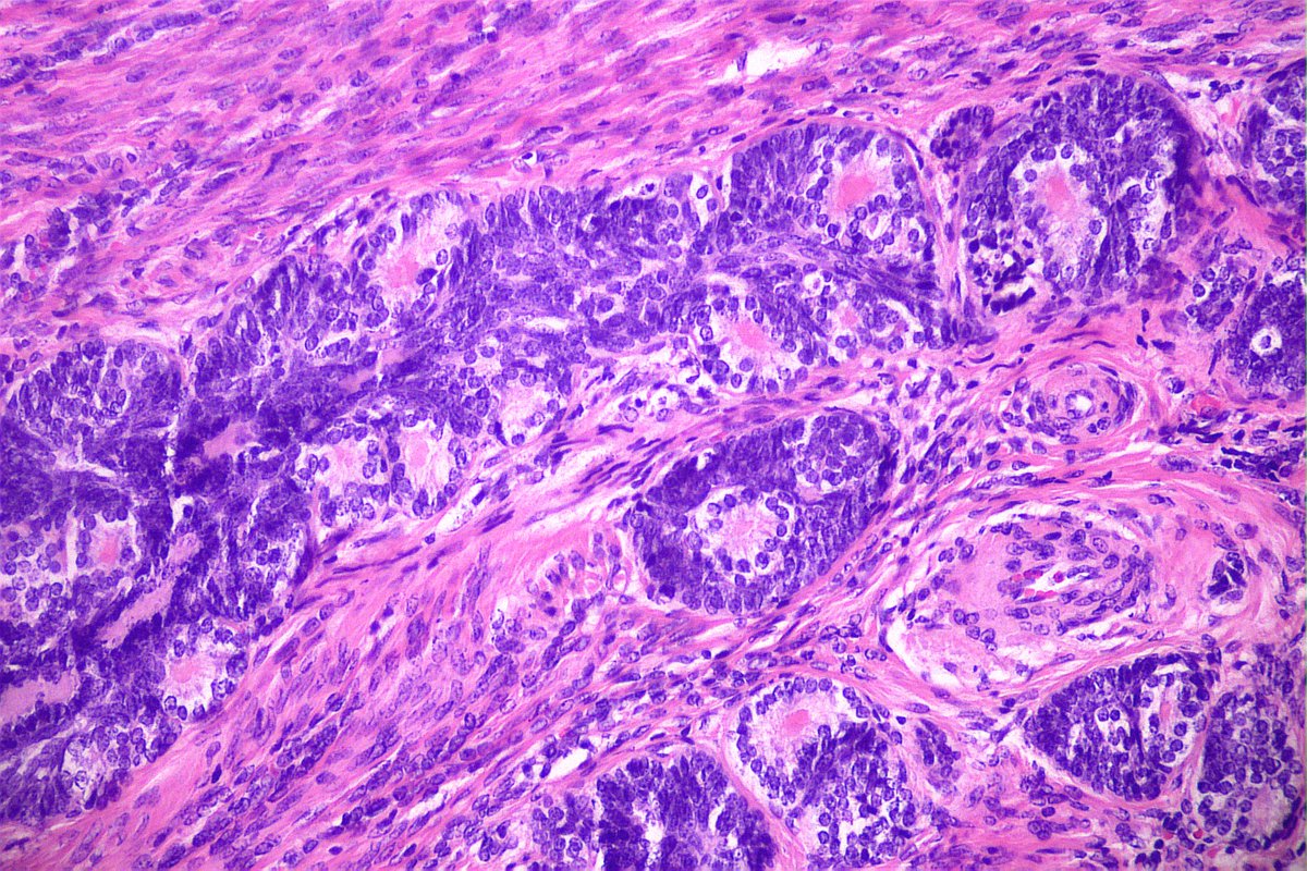 GeronimoJrLapac's tweet photo. Nice cervix adenoid basal carcinoma. HSIL adjacent.
p16+++
Adenoid basal carcinoma has no known metastatic potential when occurring in pure from , and therefore the term “adenoid basal tumour” has been suggested.
#gynpath https://t.co/EdU3FFMpRv