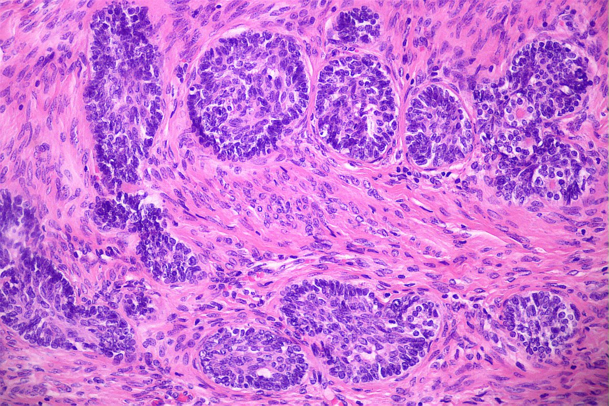 GeronimoJrLapac's tweet photo. Nice cervix adenoid basal carcinoma. HSIL adjacent.
p16+++
Adenoid basal carcinoma has no known metastatic potential when occurring in pure from , and therefore the term “adenoid basal tumour” has been suggested.
#gynpath https://t.co/EdU3FFMpRv