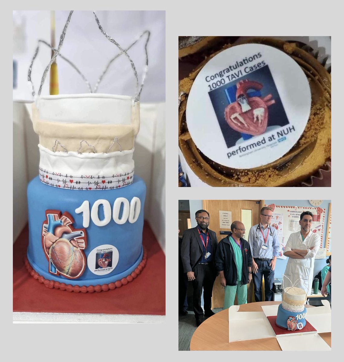 JuliaIvanova1's tweet photo. Celebrating a huge milestone of treating 1000 patients with minimalist transcatheter aortic valve intervention (TAVI) at NUH. Lifesaving treatment for patients with aortic stenosis. Amazing team work making difference to patients and their families. https://t.co/VQH3OBivkc