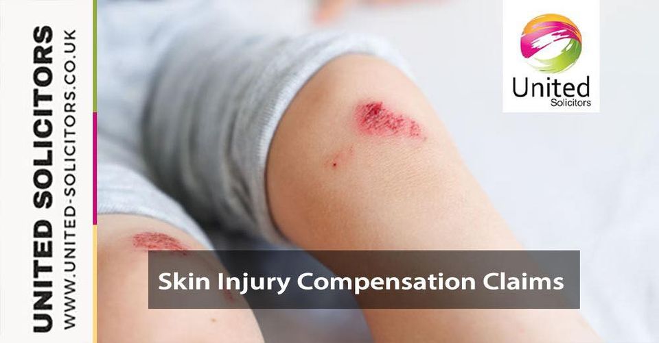 Seeking compensation for skin injuries? 
Look no further! At United Solicitors, we specialize in handling Skin Injury Compensation Claims with utmost care and expertise. 
united-solicitors.co.uk/.../skin-injur…
#SkinInjuryClaims #CompensationMatters #UnitedSolicitors