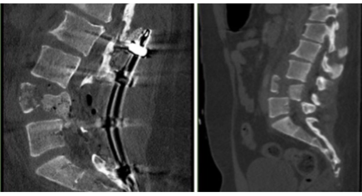 The importance of intraoperative navigation in spine trauma can not be overlooked. It took an additional scan to make sure I had a good enough reduction. #neurosurgery #spinetrauma #orthospine