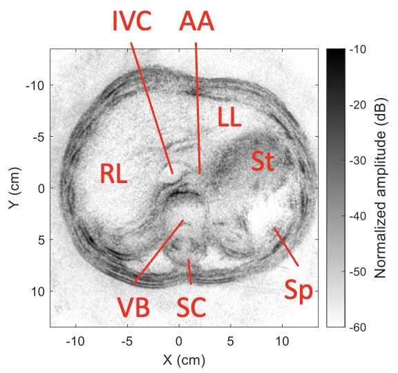 david_c_garrett's tweet photo. Here's a sneak peek of our work on whole-body ultrasound imaging. Safe and fast cross-sections of the entire human abdomen! With the talented Jinhua Xu @JXHToad 

https://t.co/5IP1u3d4e1 https://t.co/NVHoNDLyrb