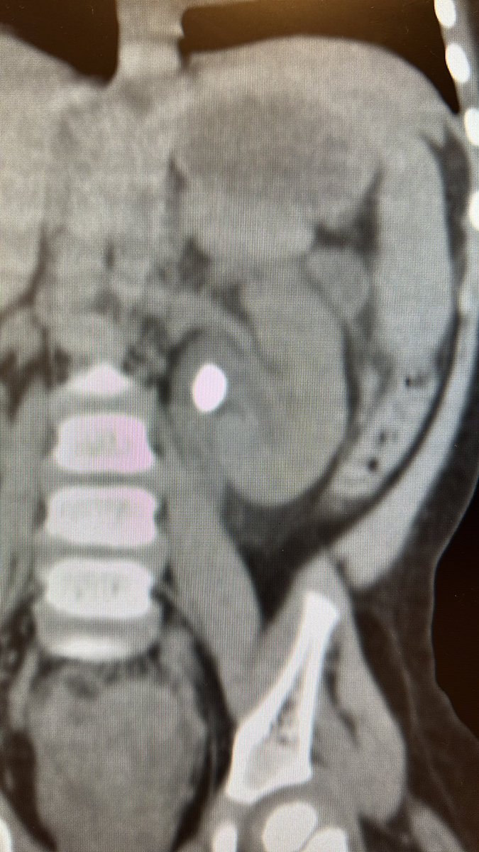 reedurokids (@reedurokids) on Twitter photo Propondrías una litotricia extracorpórea a paciente menor de 2 años, con antecedente de Pielonefritis aguda y litiasis renal de 12 mm? Cuánto tiempo después? / Would recommend SWL to under 2 yo after acute pyelonephritis? Time? #lupeyenchile #pedsendourology #endourologiaped Propondrías una litotricia extracorpórea a paciente menor de 2 años, con antecedente de Pielonefritis aguda y litiasis renal de 12 mm? Cuánto tiempo después? / Would recommend SWL to under 2 yo after acute pyelonephritis? Time? #lupeyenchile #pedsendourology #endourologiaped