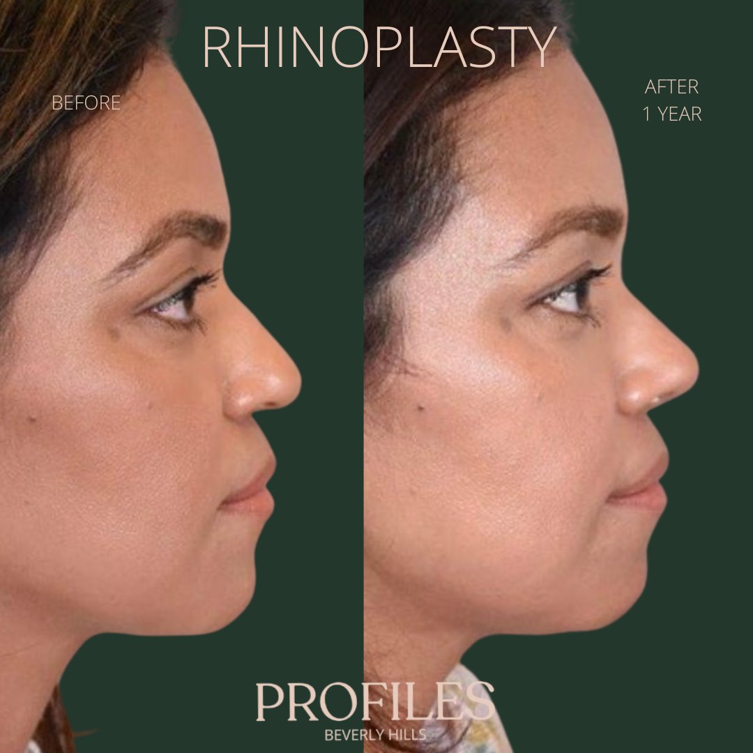 FacialPlastics's tweet photo. 📞310-276-6800
🏠 435 N Bedford Drive, PH500, Beverly Hills, 90210
👃Rhinoplasty
🗓 Before and After 1 Year
🛏 About 1 week, the cast gets taken off after 6 days

Swipe ⏩⏩⏩ for more views

Call or DM us to schedule your consultation

We also offer virtual cons... https://t.co/4VHSsEIedp