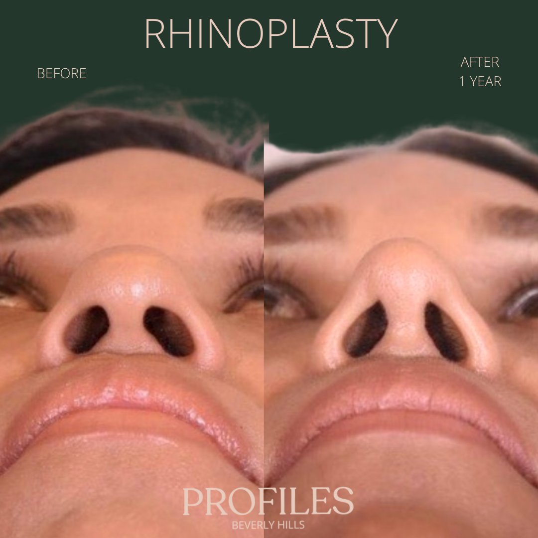 FacialPlastics's tweet photo. 📞310-276-6800
🏠 435 N Bedford Drive, PH500, Beverly Hills, 90210
👃Rhinoplasty
🗓 Before and After 1 Year
🛏 About 1 week, the cast gets taken off after 6 days

Swipe ⏩⏩⏩ for more views

Call or DM us to schedule your consultation

We also offer virtual cons... https://t.co/4VHSsEIedp
