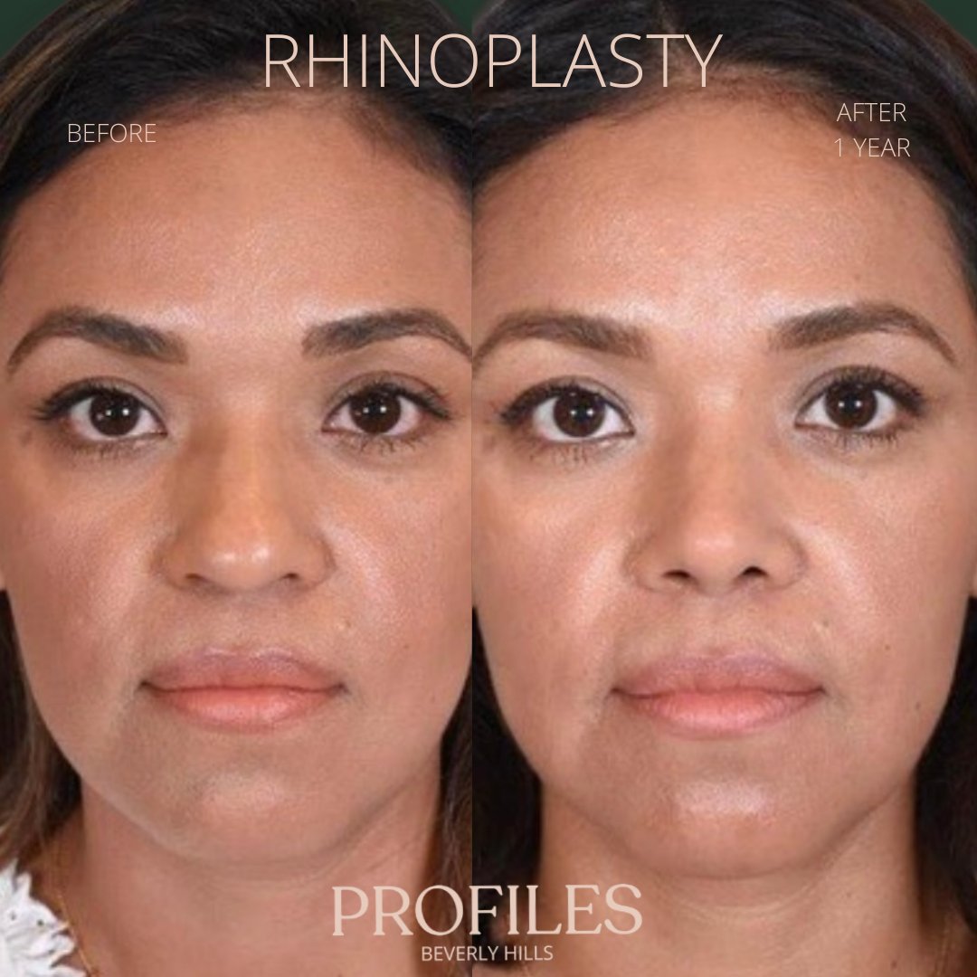 FacialPlastics's tweet photo. 📞310-276-6800
🏠 435 N Bedford Drive, PH500, Beverly Hills, 90210
👃Rhinoplasty
🗓 Before and After 1 Year
🛏 About 1 week, the cast gets taken off after 6 days

Swipe ⏩⏩⏩ for more views

Call or DM us to schedule your consultation

We also offer virtual cons... https://t.co/4VHSsEIedp