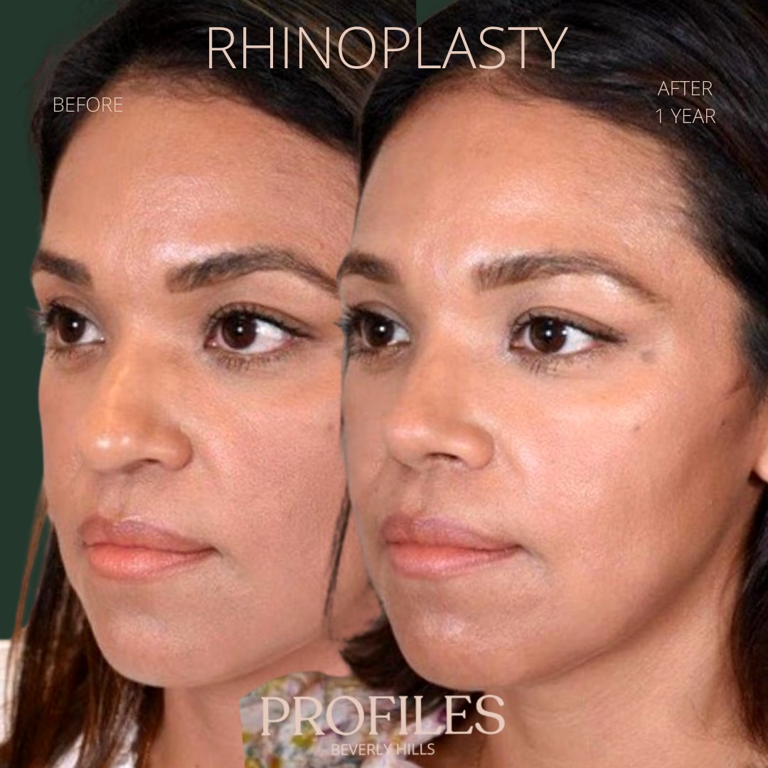 FacialPlastics's tweet photo. 📞310-276-6800
🏠 435 N Bedford Drive, PH500, Beverly Hills, 90210
👃Rhinoplasty
🗓 Before and After 1 Year
🛏 About 1 week, the cast gets taken off after 6 days

Swipe ⏩⏩⏩ for more views

Call or DM us to schedule your consultation

We also offer virtual cons... https://t.co/4VHSsEIedp
