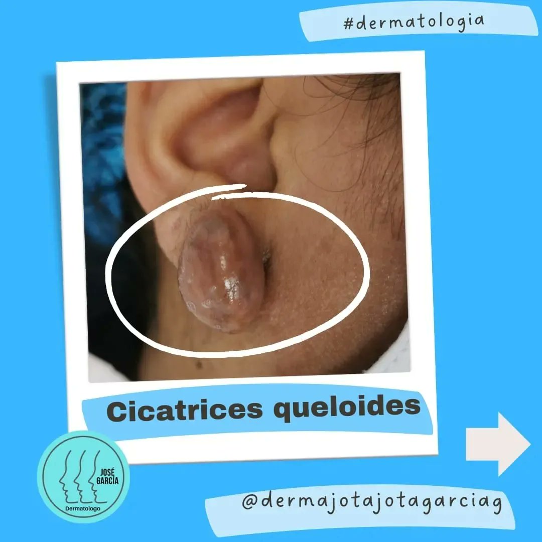 Dermajojotagar1's tweet photo. Los queloides son cicatrices exageradas que pueden generar además de dolor, molestias cosméticas por eso requieren tratamiento. 
Aquí una breve descripción de esta patología
#dermatologia #piel #queloides #dermatologosmedellín
#dermatologoscolombia https://t.co/nsa1MAS3Cc