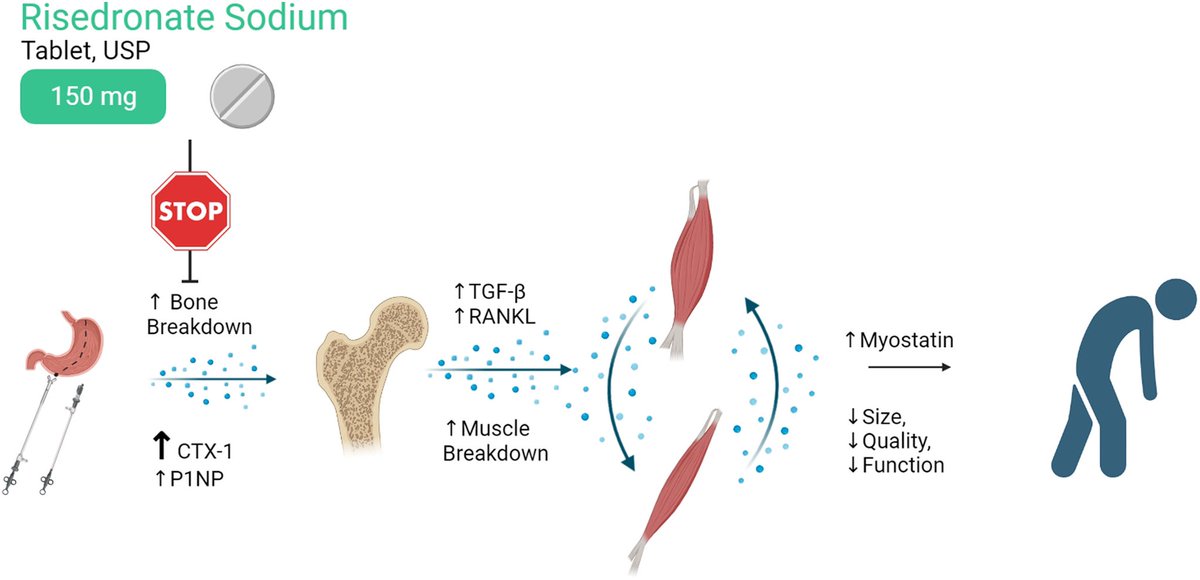 Ashley A. Weaver, PhD (@ashleyaweaver) on Twitter photo First, first-author paper by <a href="/joshrstapleton/">Joshua Stapleton</a> on our STRONG BONES study! 🦴 #bariatric #surgery sciencedirect.com/science/articl… First, first-author paper by <a href="/joshrstapleton/">Joshua Stapleton</a> on our STRONG BONES study! 🦴 #bariatric #surgery sciencedirect.com/science/articl…