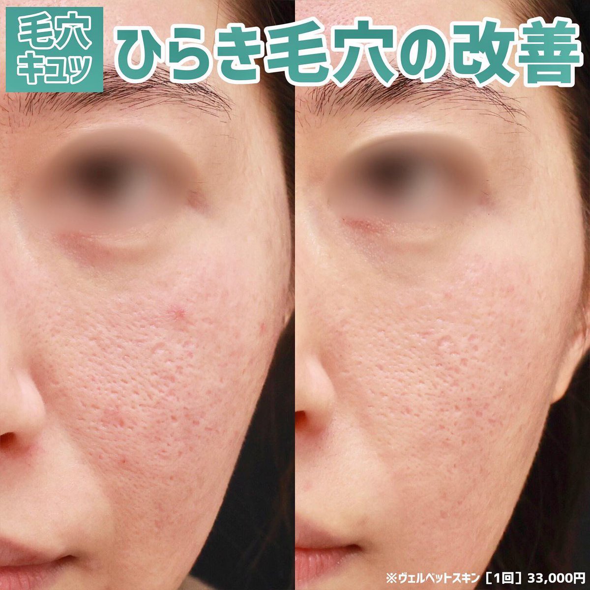 ヴェルベットスキン（全顔）※針代・麻酔代・初診料込 ベルベットスキン（全顔）\u203b針代、麻酔代、診察料込