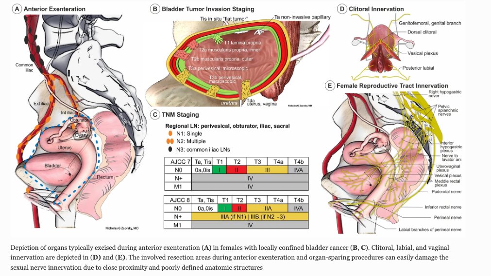 Radical cystectomy with PLND +urinary diversion in women involves removal of the uterus, cervix, fallopian tubes, ovaries, and the anterior vagina It's crucial for health providers to understand the profound impact on woman's life #WomensHealth 🧵 pubmed.ncbi.nlm.nih.gov/37419972/
