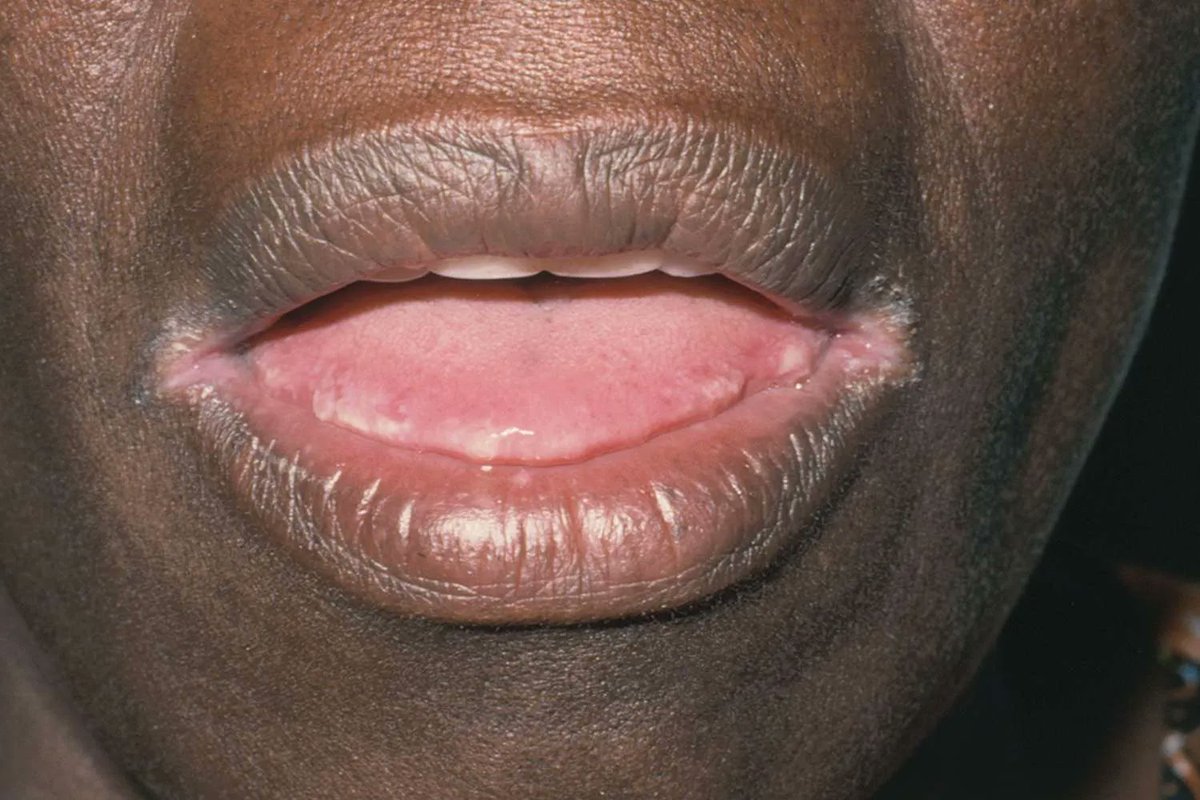 Eric on Twitter "ANGULAR CHEILITIS is a cracked corner of the mouth