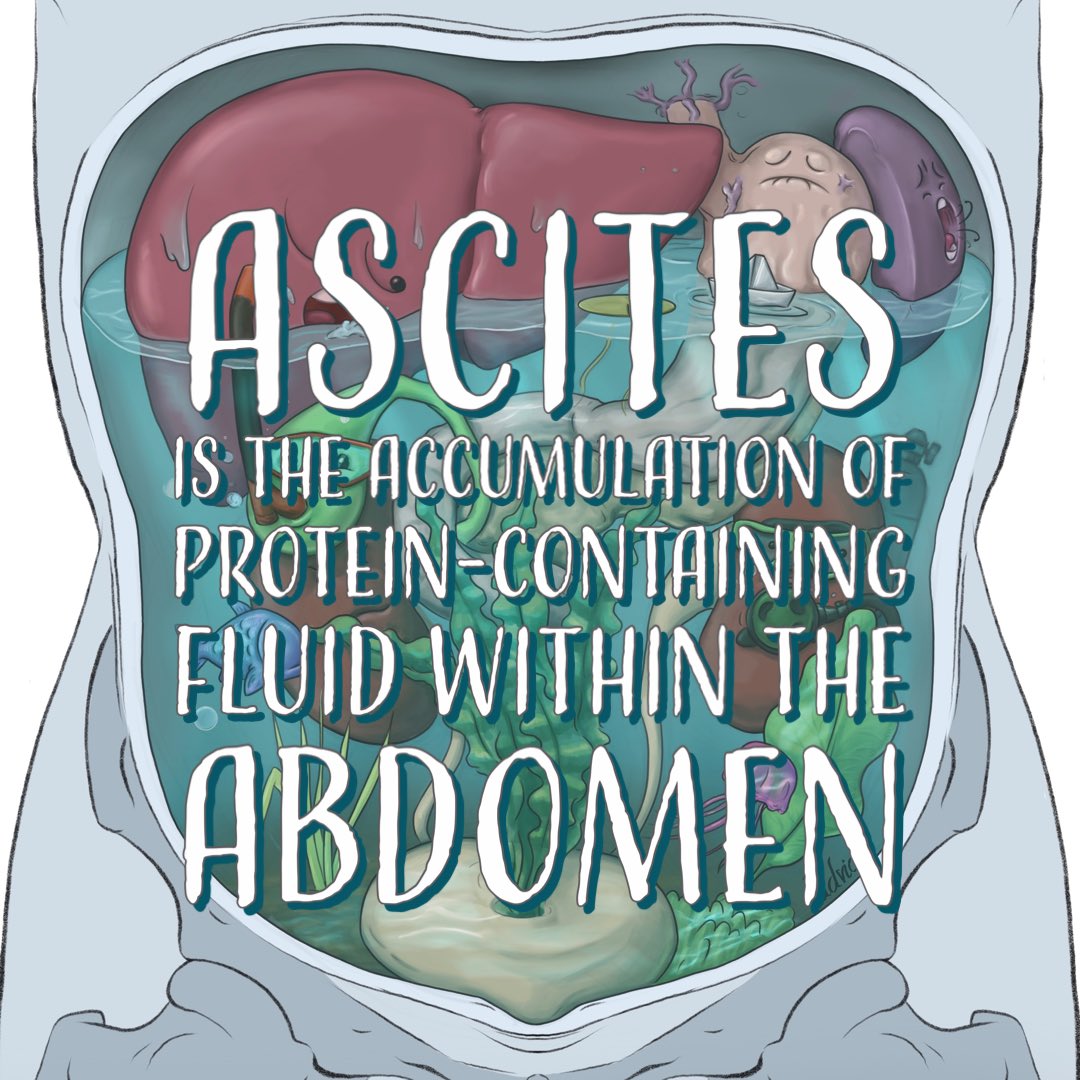 A drawing I did in 2021 about ascites. Admittedly, the liver in here may appear healthier than is typically associated with ascites, as liver disease is the most common cause but I chose not to depict a cirrhotic liver to maintain the “artistic vision”. #medicalart