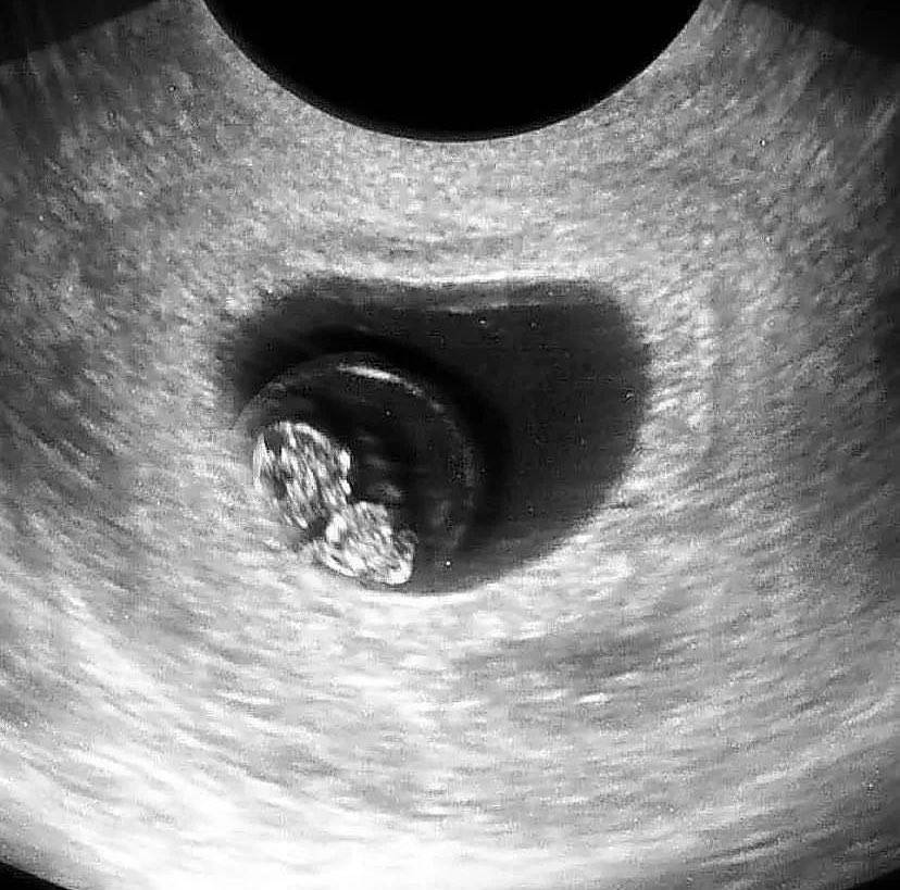 porlavida2014's tweet photo. ¿Sabías que en #7weekspregnant el cerebro del bebé se está desarrollando rápido, haciendo que la cabeza sea mucho más grande en proporción al resto del cuerpo?
#SiaLaVida https://t.co/9kTVzX6vaQ
