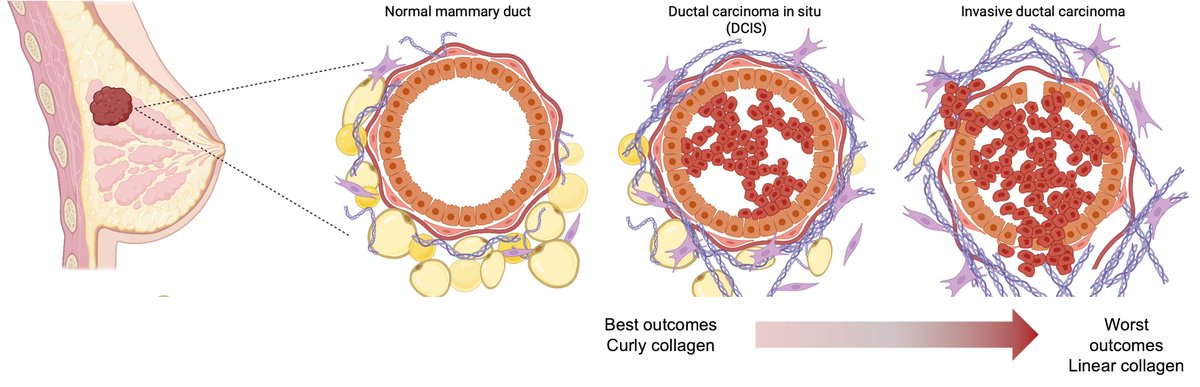 Fung shui matters – Cells care about the arrangement of their environment. In breast cancer, how proteins are arranged is predictive of prognosis.
#lifetimetc23