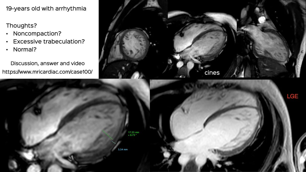 bhavinj's tweet photo. Case 100: What's in a Name? Excessive Trabeculation? Noncompaction? Does it Matter?
Discussion and video
https://t.co/VUSR6eiN0z
#cmrsimplified #cmr #cardiacmri #radres #FOAMrad #noncompaction #excessivetrabeculation https://t.co/e4qkRYAVDs