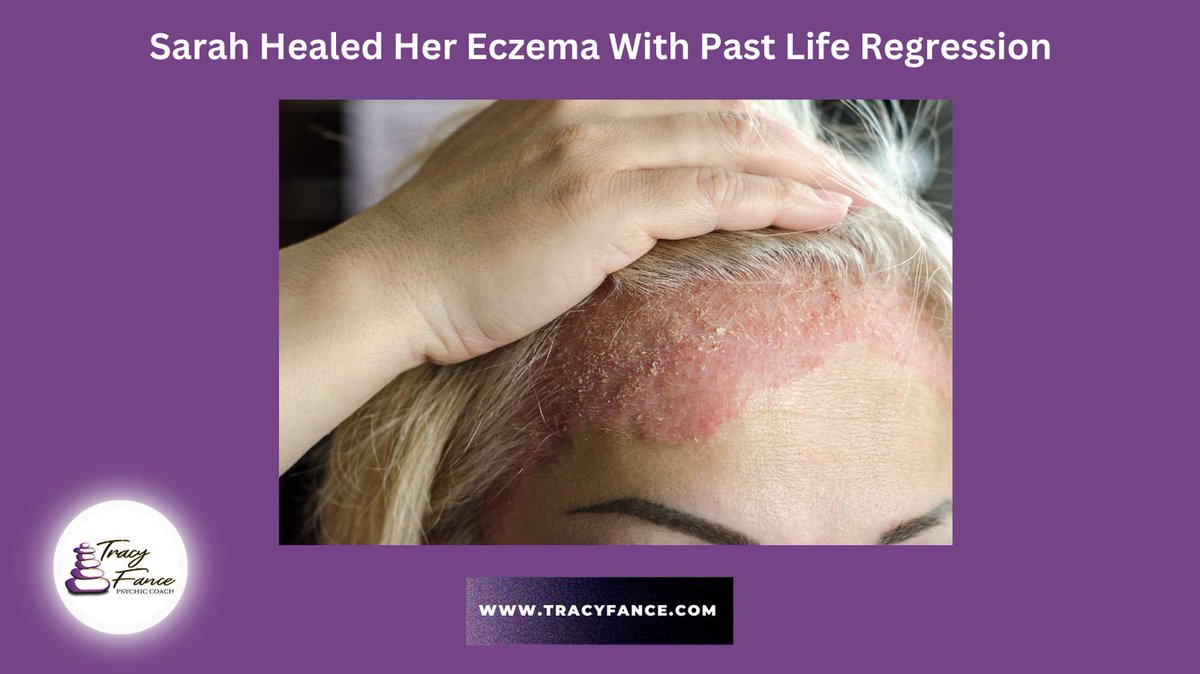 How Sarah cleared her eczema using past life regression, find out more in my newsletter conta.cc/3CXUK97 #pastliferegression #eczema #healingthepast #souljourney #coachingwithtracyfance
