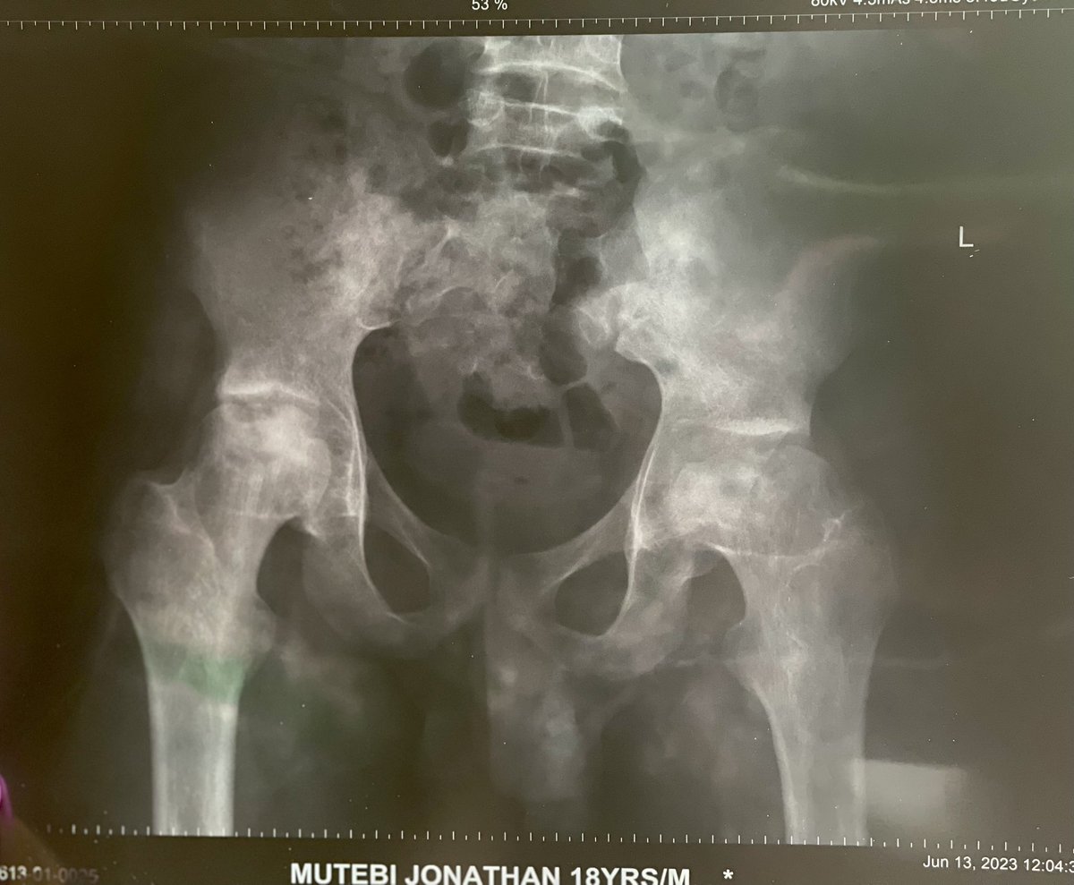 Greetings, my name is Dr. Angel Lisa Nansubuga and I would like to introduce to you the cause for my brother Mutebi Jonathan Leone.

Jonathan is a sickle cell warrior who has battled with crises since his birth and this has complicated his life.