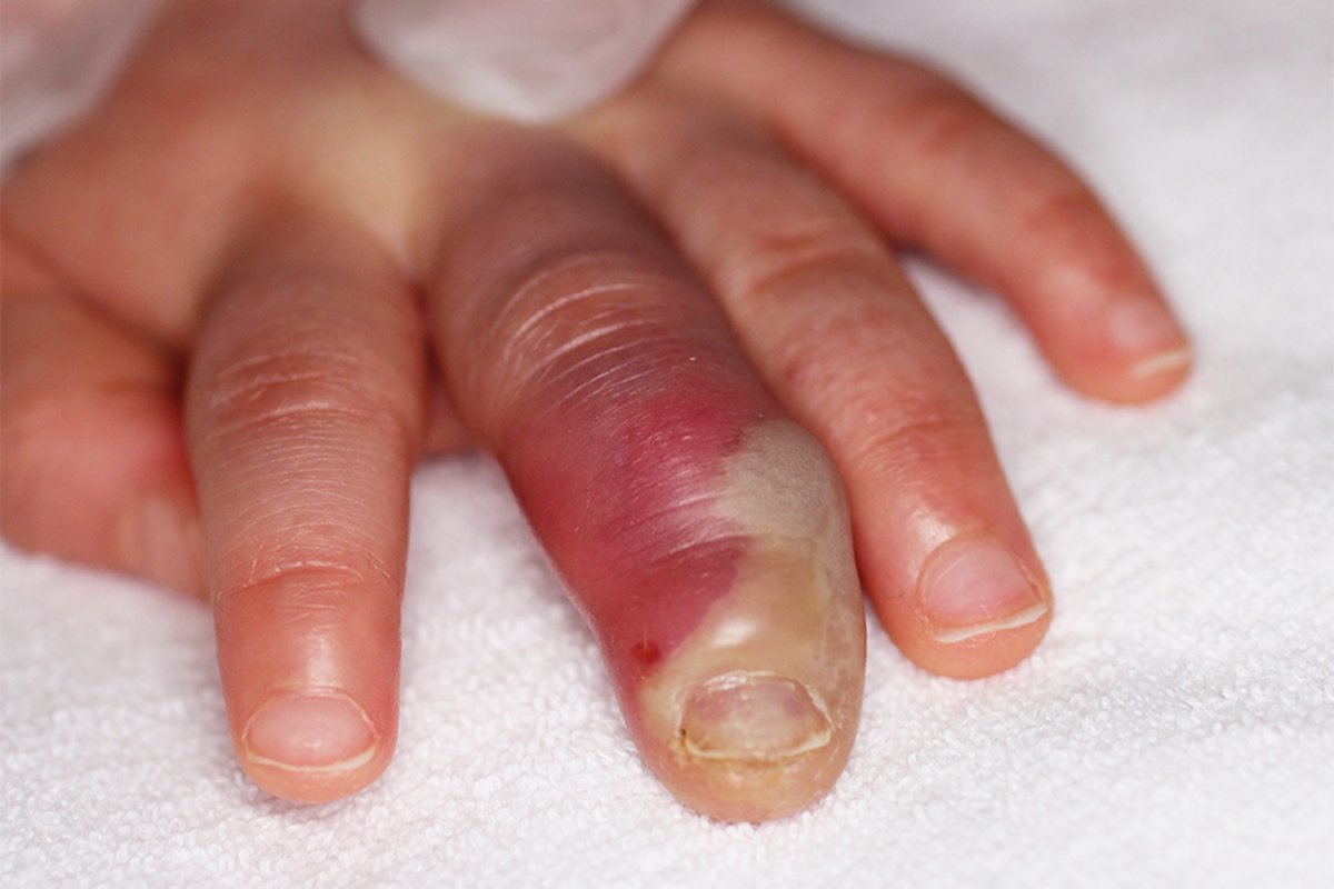 A previously healthy 1 y.o. girl with a 4-day history of fever accompanied by erythema and swelling of the left third finger, gingival inflammation, and tongue ulcerations.
- What is the diagnosis?

➡️ Answer and Full Case: manualofmedicine.com/spot-diagnosis…

#medtwitter #foamed #foamped