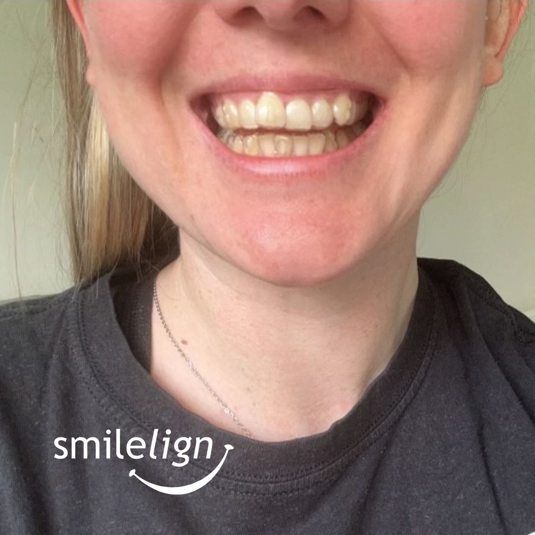 smilelign's tweet photo. Aligner set 4 of 18! 🤩 Beth's case is well and truly underway.

We wanted you to watch the progress of Beth's case, seeing first hand the results which Smilelign can achieve! 🙌 

Working with @churchfielddentalpractice to get her to her dream smile.😁 https://t.co/SAGF2RHrEE