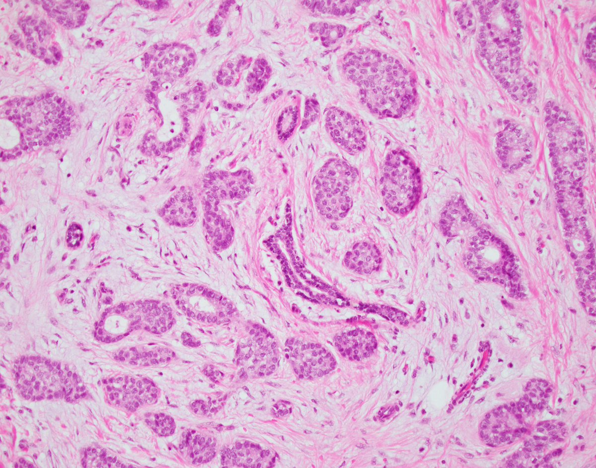 Thank you all for your participation and for helping me demonstrate a very helpful finding when it comes to differentiating invasive vs. non-invasive disease.

The image depicts invasive carcinoma with DCIS-like morphology circling and impinging on a normal duct. The distribution