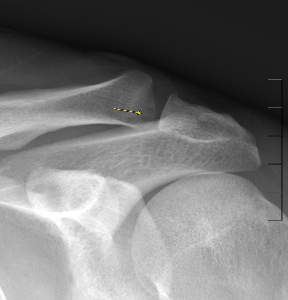 Jan Fritz on Twitter "RADIOGRAPHYMRI CORRELATION Distal Clavicle