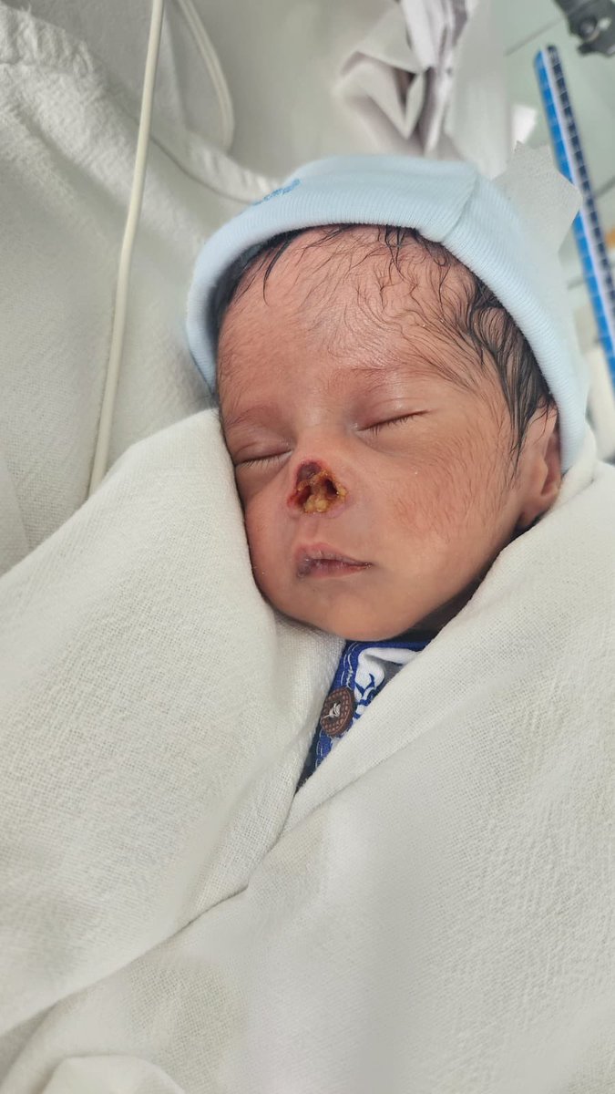 MIMshahbaz's tweet photo. No action taken against Fernandez hospital for gross medical negligence of a infant
Name fateh khan support this kid  @BRSHarish @KTRoffice @asadowaisi @IMAIndiaOrg @MoHFW_INDIA @CPHydCity @TelanganaCMO @DCPCZHyd https://t.co/UtqYJBG8pE
