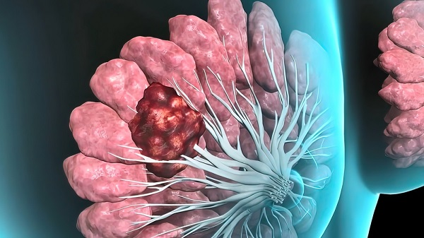 #breastcancer staging is a process used to find out how advanced the cancer is. 

The stage of the cancer depends on: 
•size and location of a tumor 
•whether it has spread 
•how far the cancer has spread #life #ScienceWorkingLife #oriele #pyt #Emeute #Science