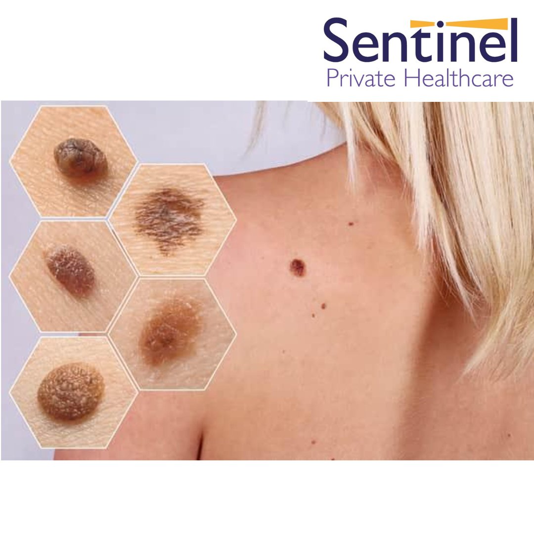 Sentinel_PHCare's tweet photo. 🌞🔬 Skin care goes beyond beauty—it's about health! Join @SentinelHealth and @CR_UK in our campaign to raise awareness about skin cancer and early detection. Protect your skin and stay informed: https://t.co/xyXVm0puNu
.
.
.
#SentinelPrivateHealthcare https://t.co/IOmQcPMlQc
