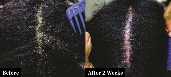 DermaSolutiongh's tweet photo. 2 for Ghc 60 p3✅️✅️

Anti-dandruff hair cream 

Treats dandruff and all scalp psoriasis

💯 effective

DM or Call 0205773069 

Kindly Retweet 🙏 

#Dermasolution
#kwadaso #STAND48 Asakaa 
She's 19  Olele https://t.co/nzH5cFrpOL