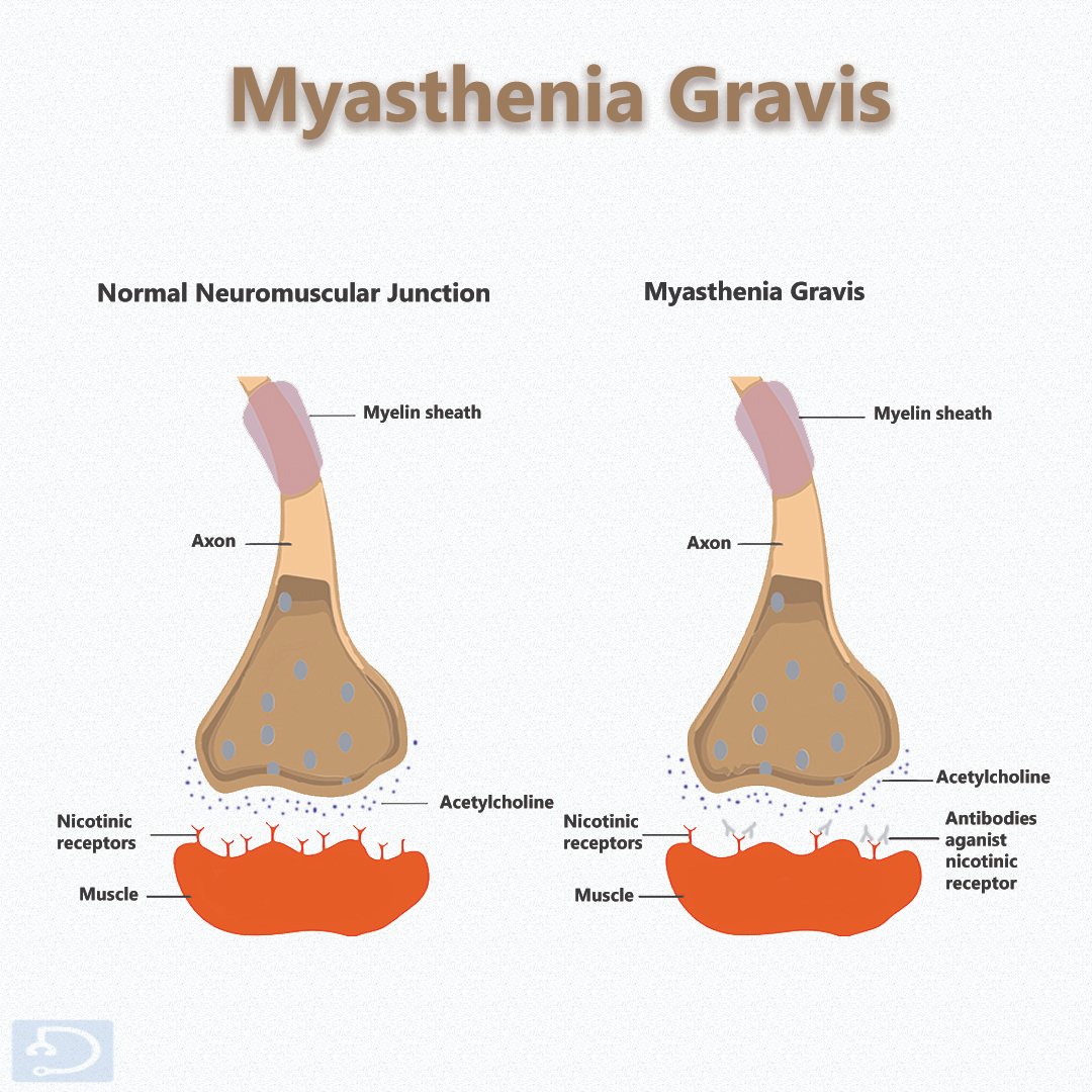 Docsteth1's tweet photo. Myasthenia Gravis affects people of all ages, including children! Be aware of the impact of this autoimmune disorder on day-to-day life.
Click here 🔗https://t.co/VYKhv0Eqi9 to learn more 🔖📚
#MyastheniaGravis #AutoimmuneDisease #MedTwitter #Docsteth #MuscleWeakness https://t.co/9sGmJvsaUS