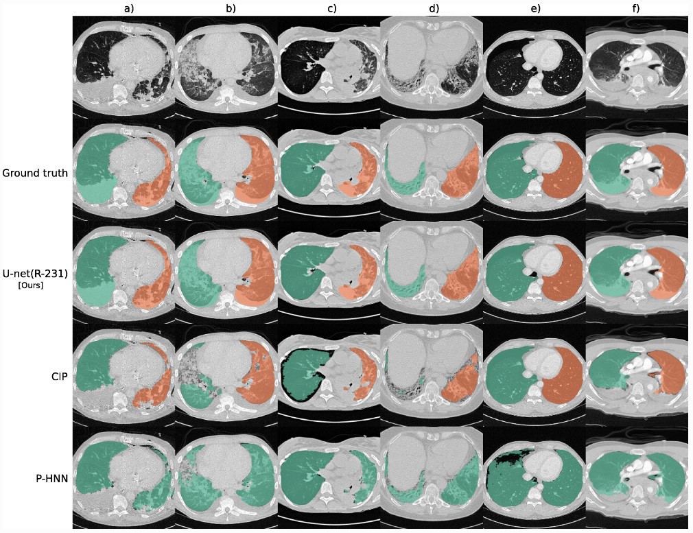 ESRJournals's tweet photo. 🥇 And finally, our sincere congratulations to the most cited #EuropeanRadiologyExperimental article in 2022, which highlights the importance of #data diversity when developing and training #DeepLearning models!

🎉 Well done to @joh_hof et al.!

🔗 https://t.co/okIkFu7ZIw https://t.co/PeOVgIpkx1