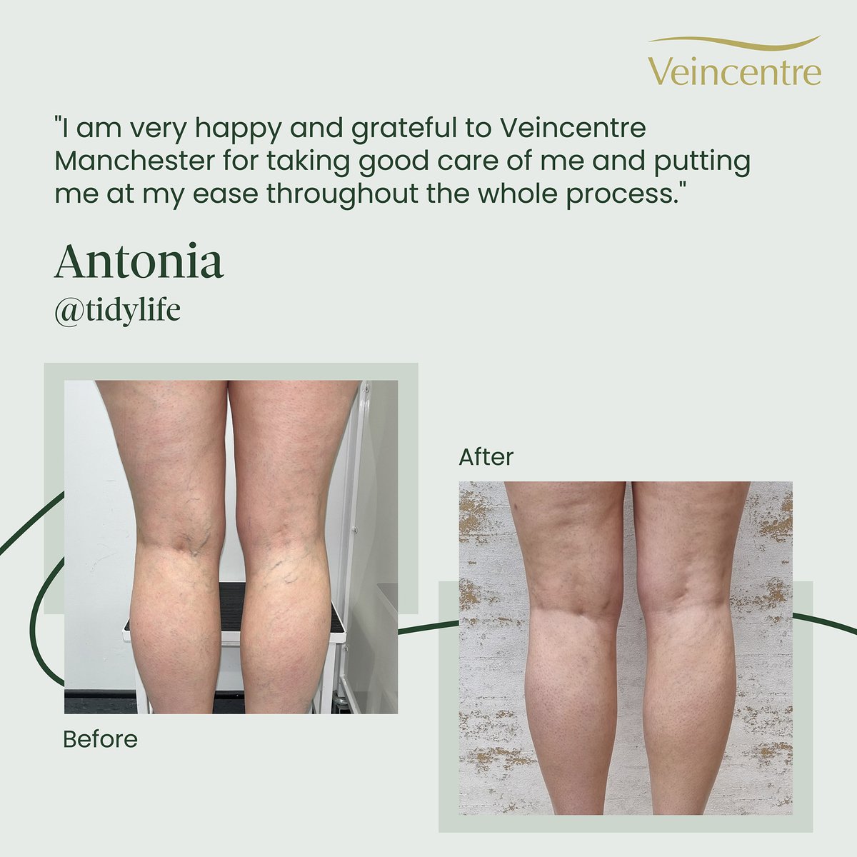 veincentreltd's tweet photo. Interior & lifestyle influencer Antonia, aka @thisistidylife sought treatment with us after years of suffering with varicose veins and thread veins.
Read more: https://t.co/mCIbLUGUvz
#varicoseveins #threadveins #transformation #beforeandafter #resultsmatter https://t.co/uwu3LjCa6Y