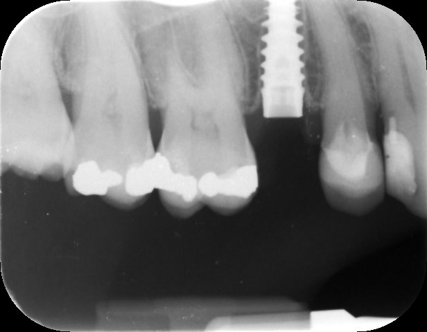 droitwichspaden's tweet image. Broken tooth … A dental implant is a good solution to replace an un-restorable tooth . #DentalImplants #StraumannImplants #StraumannBLX #ImplantDentistry