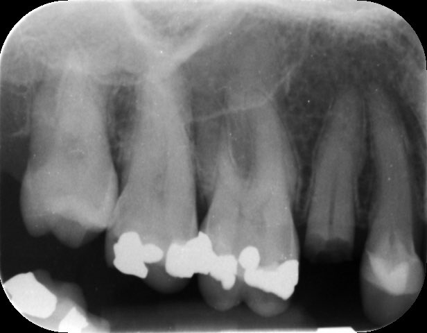 droitwichspaden's tweet image. Broken tooth … A dental implant is a good solution to replace an un-restorable tooth . #DentalImplants #StraumannImplants #StraumannBLX #ImplantDentistry