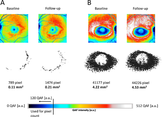 Thomas Ach et al. @Uniklinikum_Wue report quantitative fundus autofluorescence results in a one year follow up after systemic chloroquine/ hydroxychloroquine therapy. 
https://t.co/SStzflcwR0 https://t.co/jM5l8eFGf3