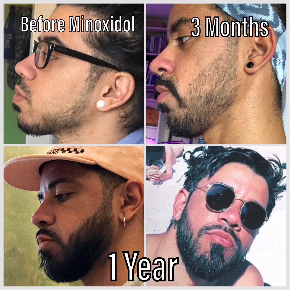 My Beard Growth Journey

1 year of using Minoxidil 

Age 32 to 33

Yes, most of my 20s I couldn’t grow much facial hair

Now I can grow a full beard

Every Man deserves the possibility to grow a thick, luscious masculine beard

If You can’t grow a beard 

Use Minoxidil ASAP!